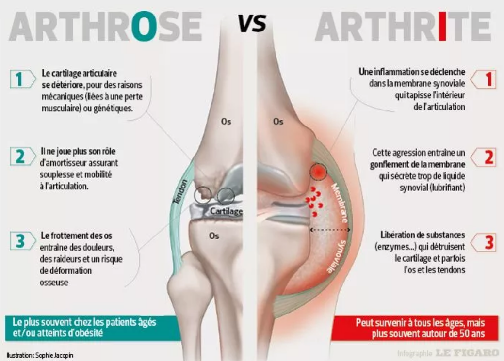 arthrose